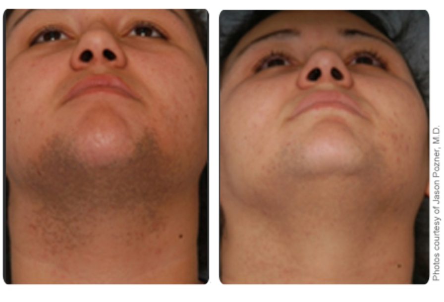 Hair Removal Results Carrollton