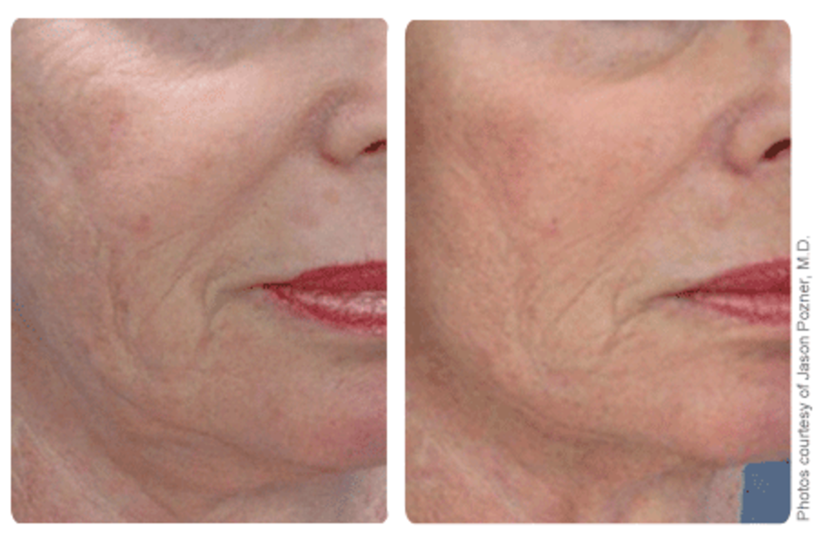 Skin Tightening Carrollton